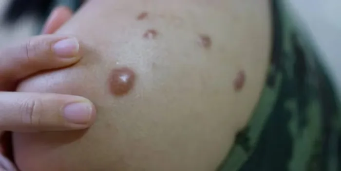 Confirman el primer caso de la nueva variante del mpox en Tailandia
